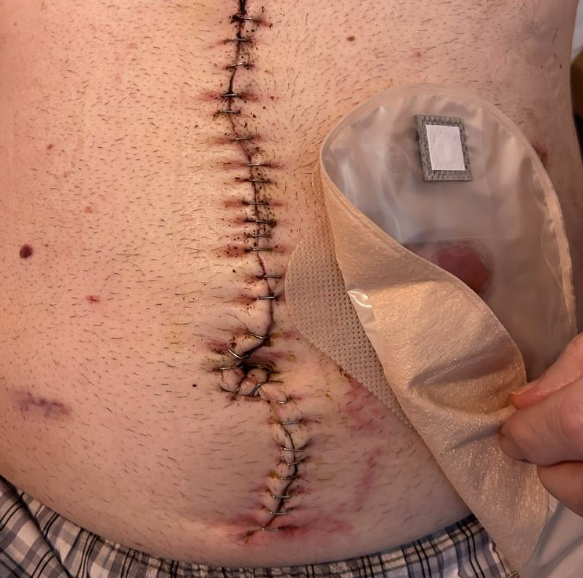 Roger had 32 staples inserted